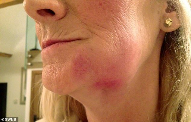 Ms Gillett first had dental work done by Dr Raj Mistry at Portland Dental Care, in Lincoln, in 2011 to get implants. She was left with swelling and pain